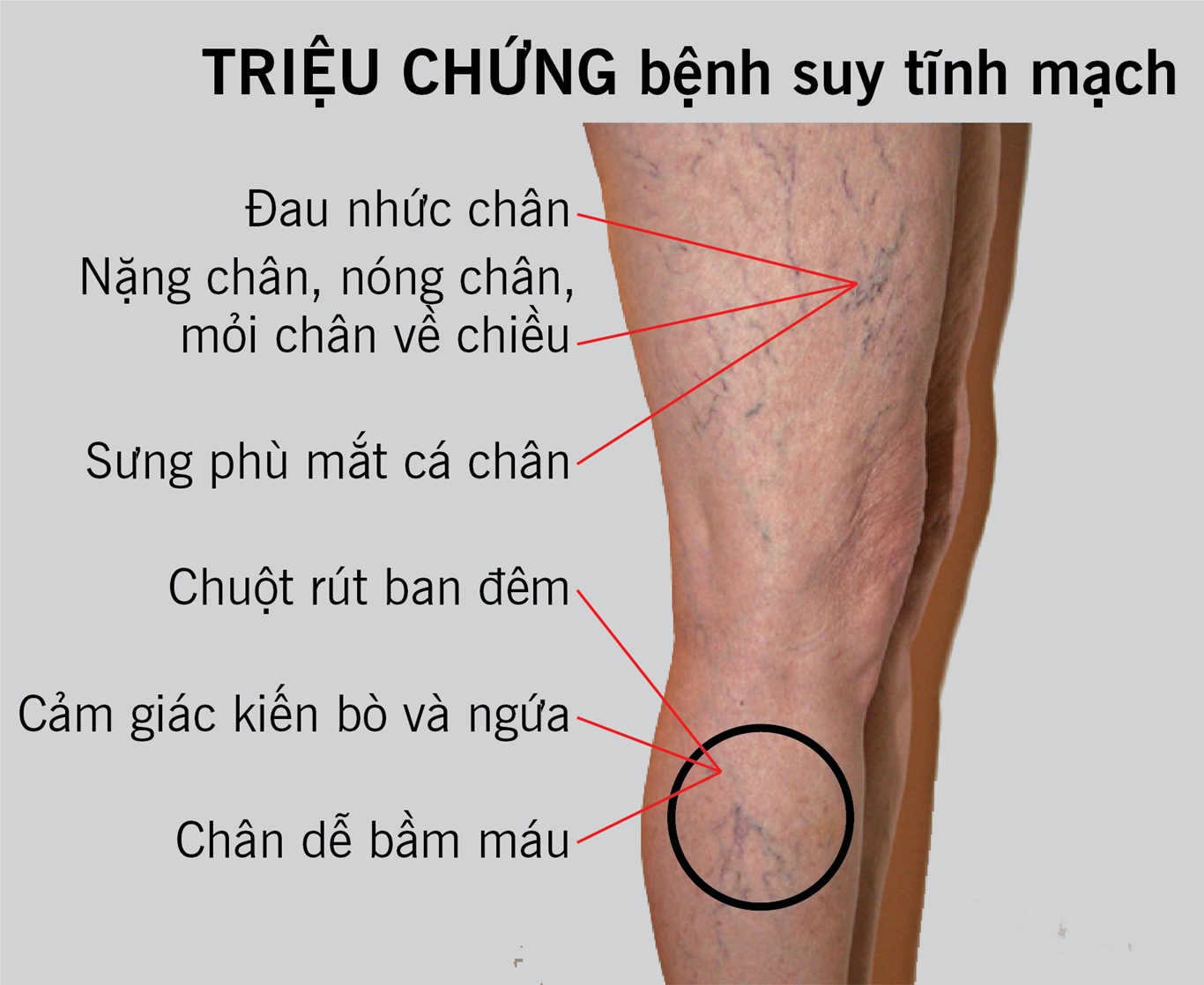 suy giãn tĩnh mạch là gì?